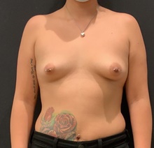 Breast Augmentation Before Photo by Johnny Franco, MD; Austin, TX - Case 45747