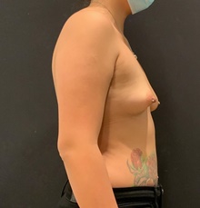 Breast Augmentation Before Photo by Johnny Franco, MD; Austin, TX - Case 45747