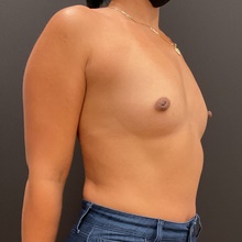 Breast Augmentation Before Photo by Johnny Franco, MD; Austin, TX - Case 45748