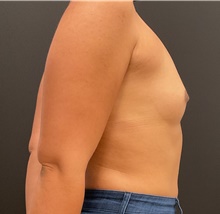 Breast Augmentation Before Photo by Johnny Franco, MD; Austin, TX - Case 45748