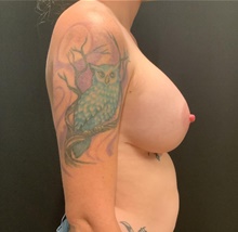 Breast Augmentation After Photo by Johnny Franco, MD; Austin, TX - Case 45749