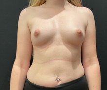 Breast Augmentation Before Photo by Johnny Franco, MD; Austin, TX - Case 45750