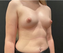 Breast Augmentation Before Photo by Johnny Franco, MD; Austin, TX - Case 45750