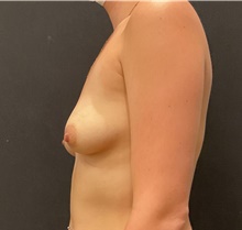 Breast Augmentation Before Photo by Johnny Franco, MD; Austin, TX - Case 45754