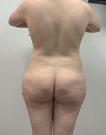 Buttock Lift with Augmentation Before Photo by Johnny Franco, MD; Austin, TX - Case 45756