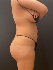 Buttock Lift with Augmentation Before Photo by Johnny Franco, MD; Austin, TX - Case 45758