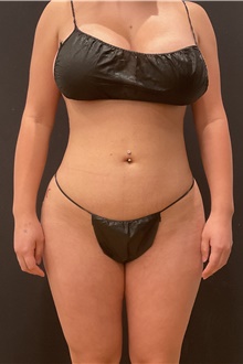 Buttock Lift with Augmentation After Photo by Johnny Franco, MD; Austin, TX - Case 45810