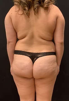 Buttock Lift with Augmentation Before Photo by Johnny Franco, MD; Austin, TX - Case 45811