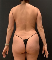 Buttock Lift with Augmentation Before Photo by Johnny Franco, MD; Austin, TX - Case 45812