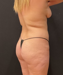 Buttock Lift with Augmentation Before Photo by Johnny Franco, MD; Austin, TX - Case 45841
