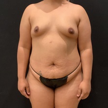 Tummy Tuck Before Photo by Johnny Franco, MD; Austin, TX - Case 45872