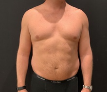 Liposuction Before Photo by Johnny Franco, MD; Austin, TX - Case 45875