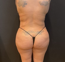 Buttock Lift with Augmentation After Photo by Johnny Franco, MD; Austin, TX - Case 48741