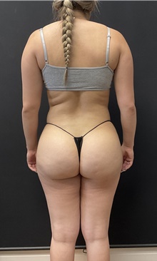Buttock Lift with Augmentation After Photo by Johnny Franco, MD; Austin, TX - Case 48786