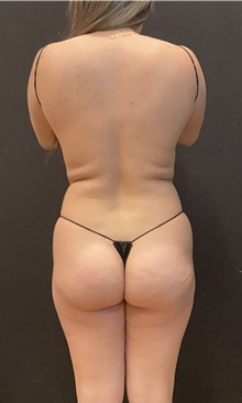Buttock Lift with Augmentation Before Photo by Johnny Franco, MD; Austin, TX - Case 48786