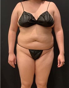 Tummy Tuck Before Photo by Johnny Franco, MD; Austin, TX - Case 49018