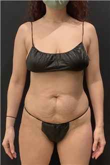 Tummy Tuck Before Photo by Johnny Franco, MD; Austin, TX - Case 49019