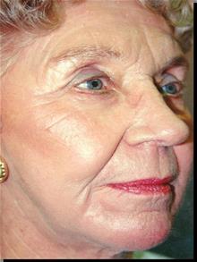 Chemical Peels, IPL, Fractional CO2 Laser Treatments After Photo by Joseph Rucker, MD; Eau Claire, WI - Case 29439