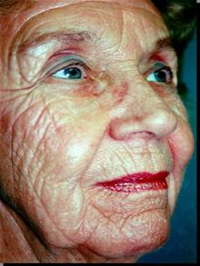 Chemical Peels, IPL, Fractional CO2 Laser Treatments Before Photo by Joseph Rucker, MD; Eau Claire, WI - Case 29439