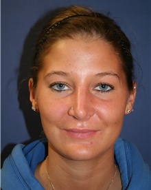 Rhinoplasty After Photo by Joseph Rucker, MD; Eau Claire, WI - Case 29440