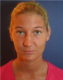 Rhinoplasty Before Photo by Joseph Rucker, MD; Eau Claire, WI - Case 29440