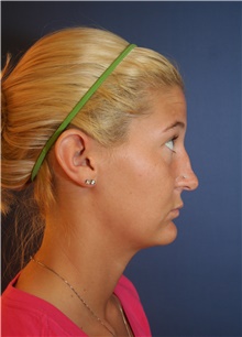 Rhinoplasty Before Photo by Joseph Rucker, MD; Eau Claire, WI - Case 29440