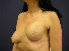 Breast Reconstruction Before Photo by Joseph Rucker, MD; Eau Claire, WI - Case 29443