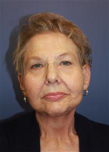 Facelift After Photo by Joseph Rucker, MD; Eau Claire, WI - Case 29445