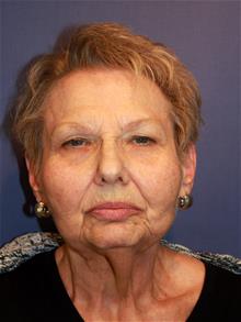 Facelift Before Photo by Joseph Rucker, MD; Eau Claire, WI - Case 29445