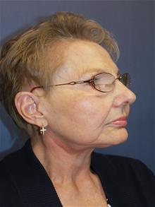 Facelift After Photo by Joseph Rucker, MD; Eau Claire, WI - Case 29445