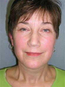 Facelift After Photo by Joseph Rucker, MD; Eau Claire, WI - Case 29446