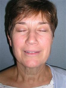 Facelift Before Photo by Joseph Rucker, MD; Eau Claire, WI - Case 29446