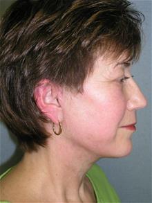 Facelift After Photo by Joseph Rucker, MD; Eau Claire, WI - Case 29446