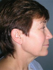 Facelift Before Photo by Joseph Rucker, MD; Eau Claire, WI - Case 29446