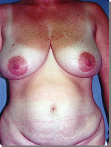 Breast Reduction Before Photo by Joseph Rucker, MD; Eau Claire, WI - Case 29451