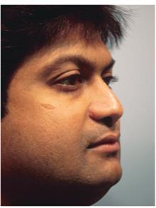 Rhinoplasty After Photo by Joseph Rucker, MD; Eau Claire, WI - Case 29456