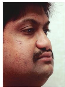 Rhinoplasty Before Photo by Joseph Rucker, MD; Eau Claire, WI - Case 29456