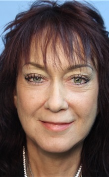 Facelift After Photo by Richard Clark, MD; Carmichael, CA - Case 34613