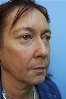 Facelift Before Photo by Richard Clark, MD; Carmichael, CA - Case 34613