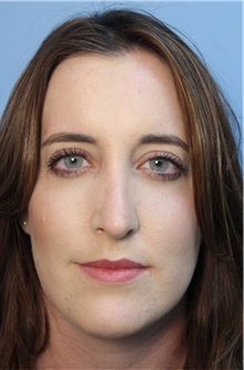 Rhinoplasty After Photo by Richard Clark, MD; Carmichael, CA - Case 34616