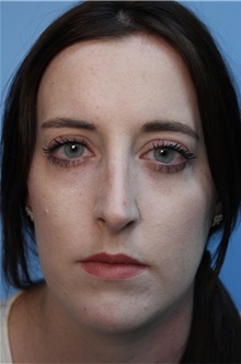 Rhinoplasty Before Photo by Richard Clark, MD; Carmichael, CA - Case 34616
