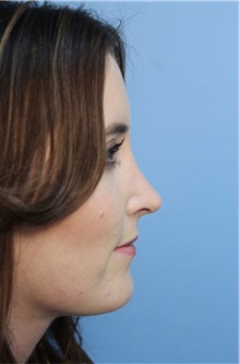 Rhinoplasty After Photo by Richard Clark, MD; Carmichael, CA - Case 34616