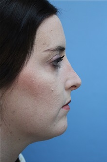 Rhinoplasty Before Photo by Richard Clark, MD; Carmichael, CA - Case 34616
