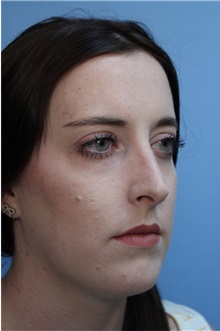 Rhinoplasty Before Photo by Richard Clark, MD; Carmichael, CA - Case 34616