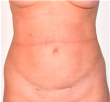 Liposuction After Photo by David Rapaport, MD; New York, NY - Case 40441
