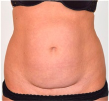 Liposuction Before Photo by David Rapaport, MD; New York, NY - Case 40441