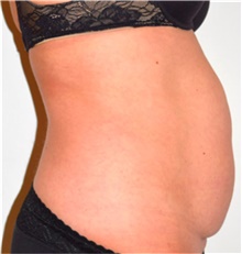 Liposuction Before Photo by David Rapaport, MD; New York, NY - Case 40441
