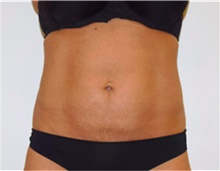 Liposuction After Photo by David Rapaport, MD; New York, NY - Case 40442