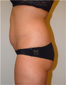 Liposuction Before Photo by David Rapaport, MD; New York, NY - Case 40442