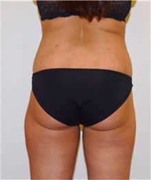 Liposuction After Photo by David Rapaport, MD; New York, NY - Case 40442